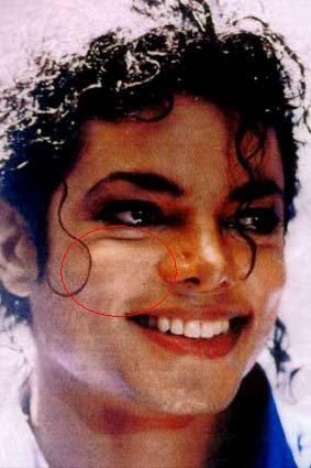 Vitiligo - Die gebleichte Haut
